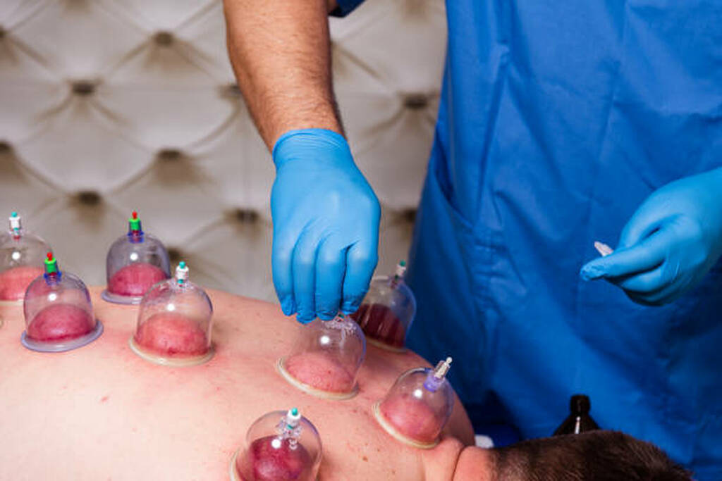 Hijama Massage Cupping | Hijama Cure Lahore