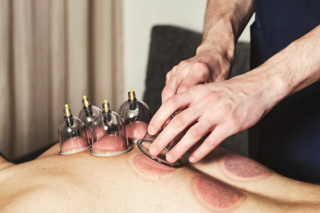 Is Hijama a Form of Chiropractic Treatment?