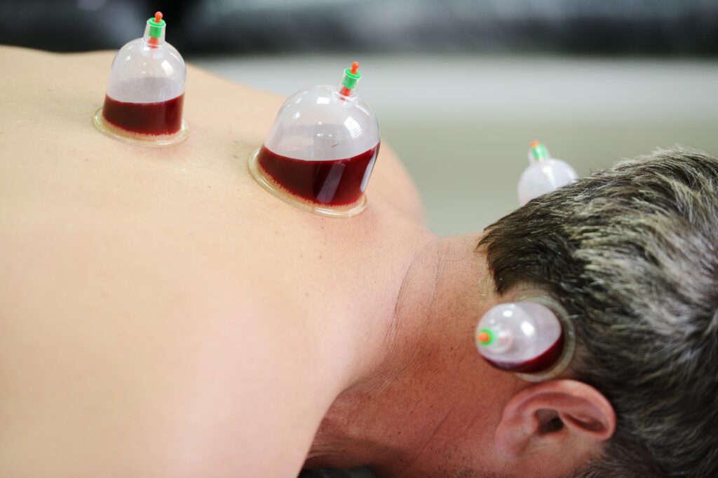 Types of Hijama Cupping | Hijama Cure