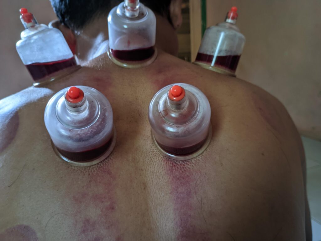 Hijama Can Improve Your Post‑Surgery Recovery