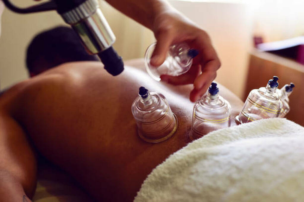 Cupping therapy