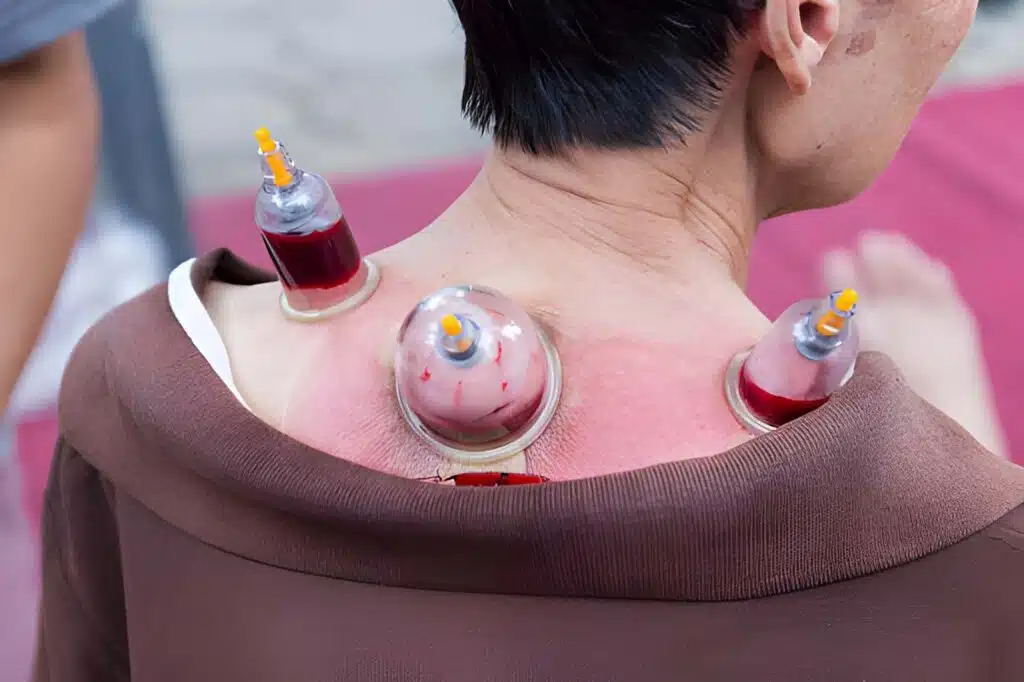 How Hijama Wet Cupping Can Boost Male Fertility