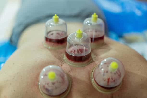 Wet Cupping Therapy