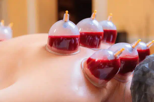 Why Wet Cupping Therapy Is Gaining Popularity