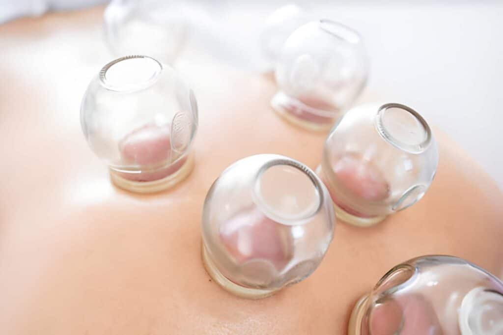 Hijama Help You Recover After a Bodybuilding