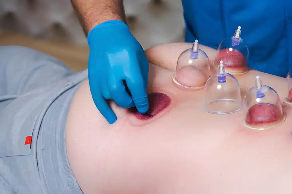 Hijama for Belly Fat Everything | You Need to Know