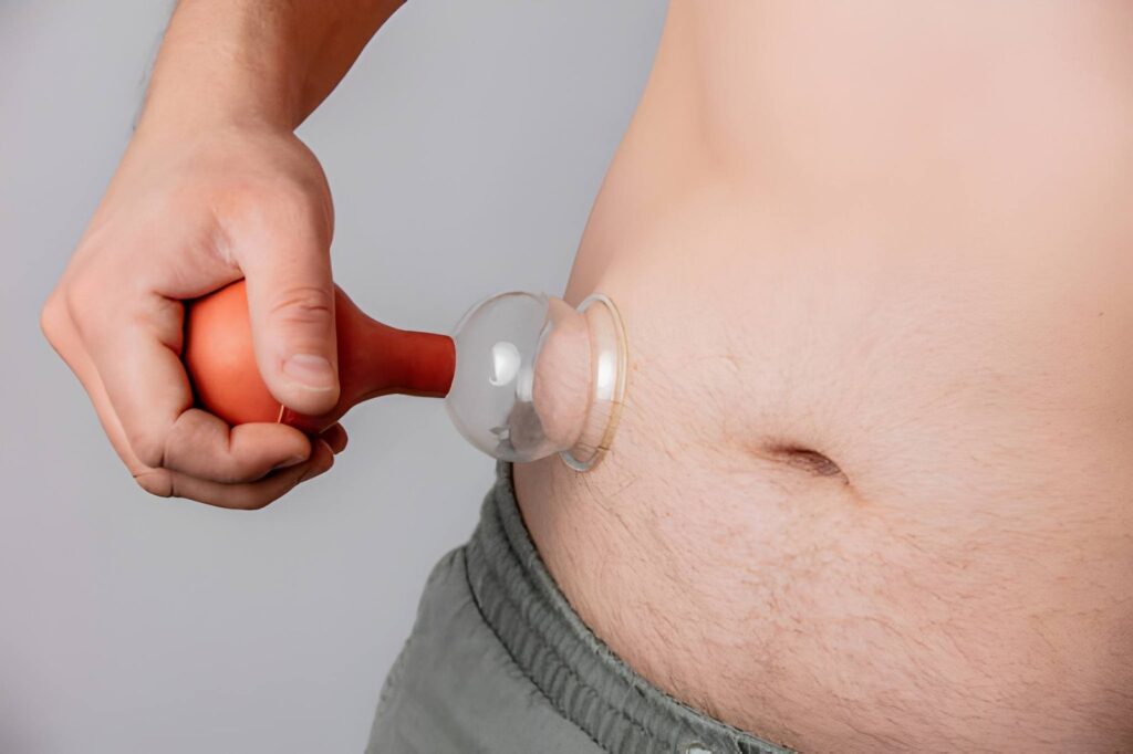 How is Cupping Therapy helpful for Belly Fat Reduction?
